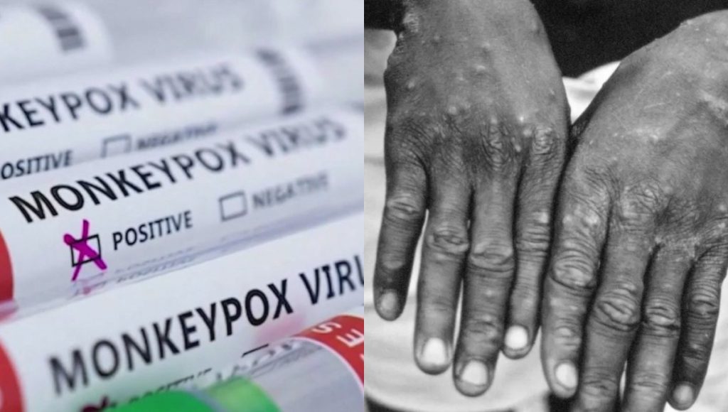 Two Mpox cases confirmed at Kang’undo Level 4 Hospital