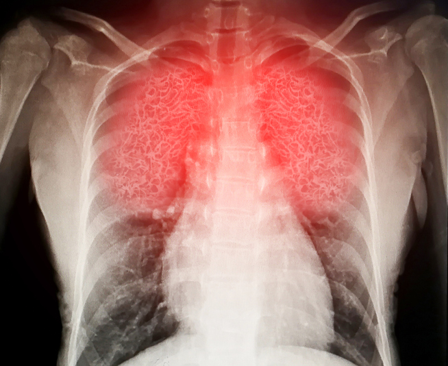 Key differences between asthma and pneumonia: Dr. Tonny explains, urges proper diagnosis.