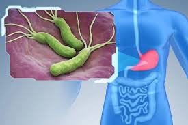 How H. pylori and Ulcers Differ